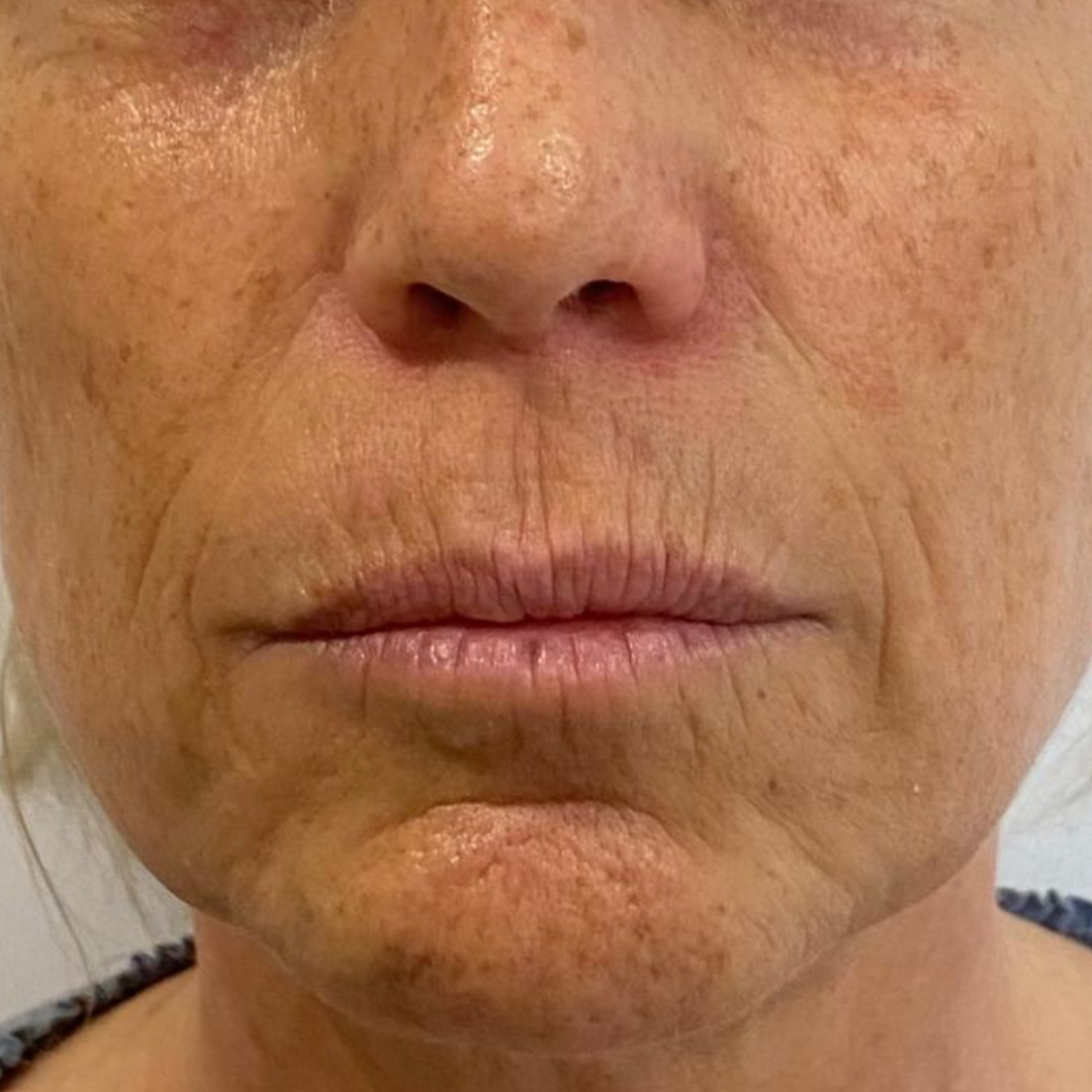 Hidratación de labios y eliminación de código de barras